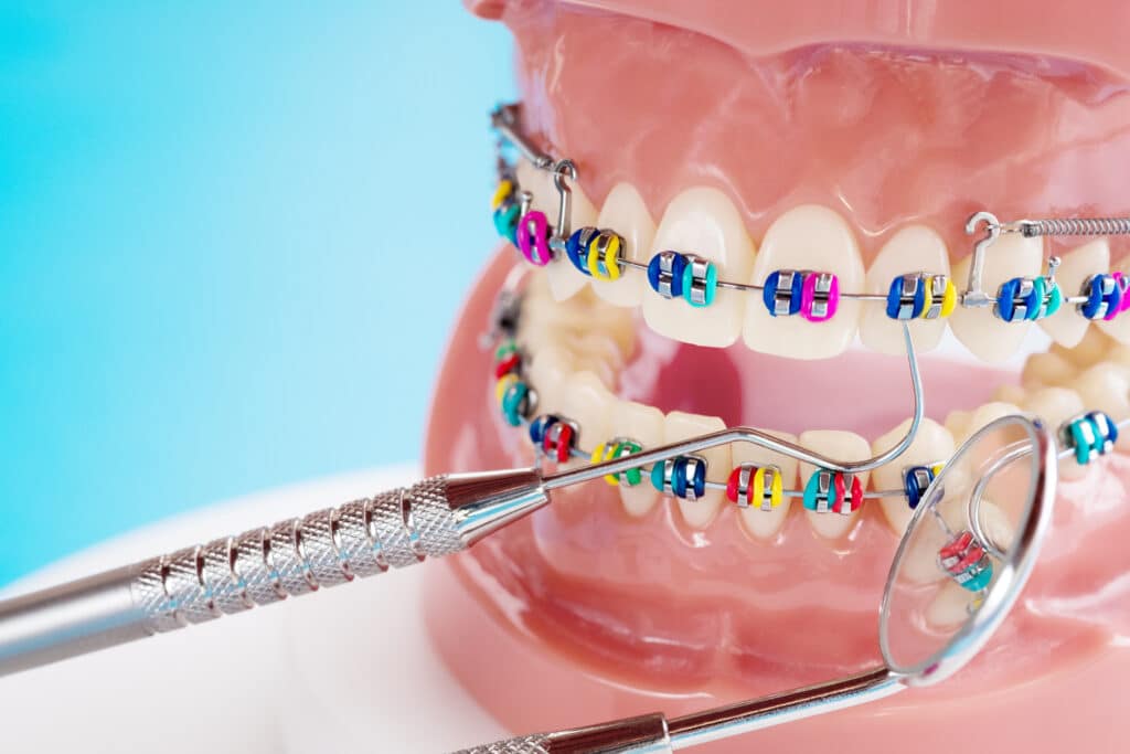 image of braces on teeth