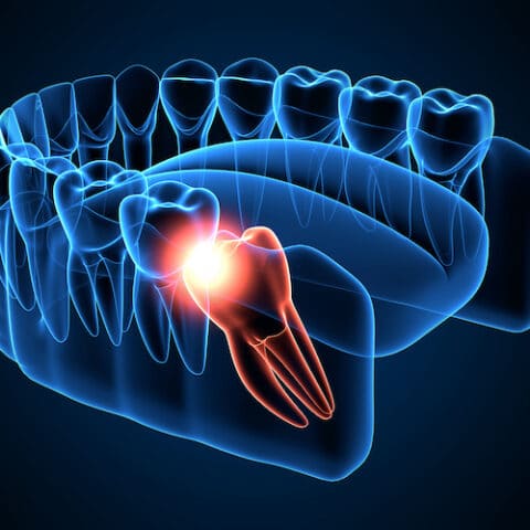 3d image of broken wisdom tooth