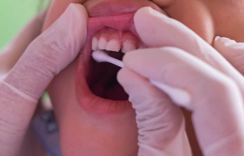 image of fluoride on teeth