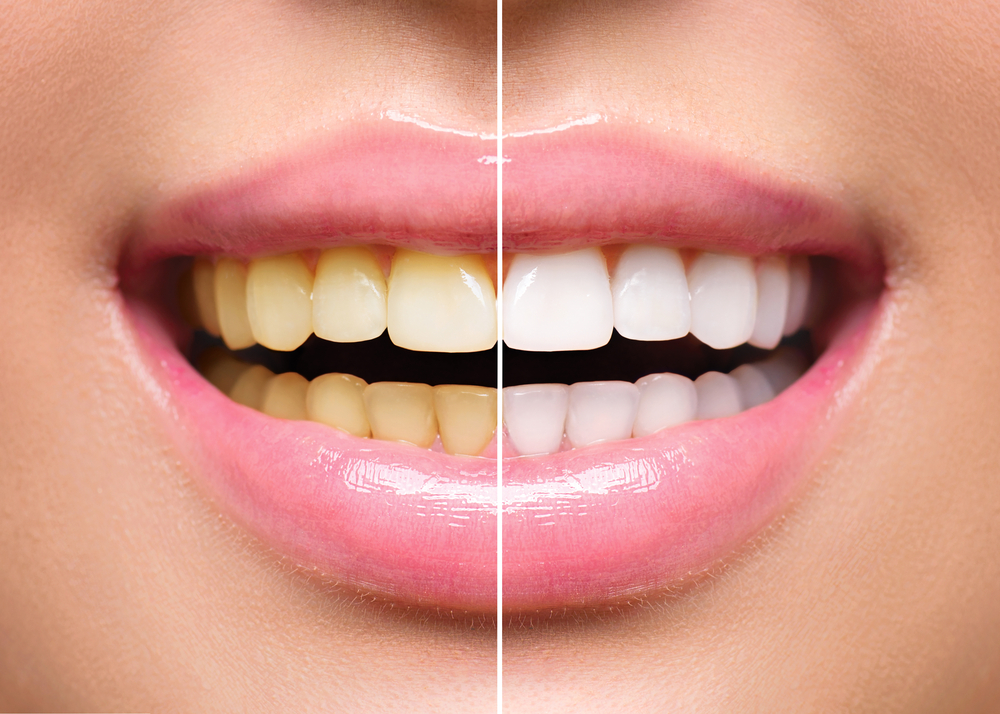 Best Teeth Whitening Method cosmetic dentistry Polished A Dental