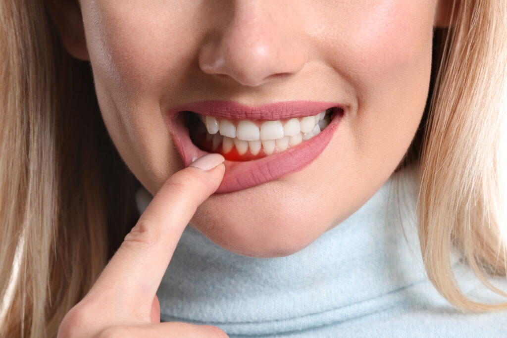 image of womans gums