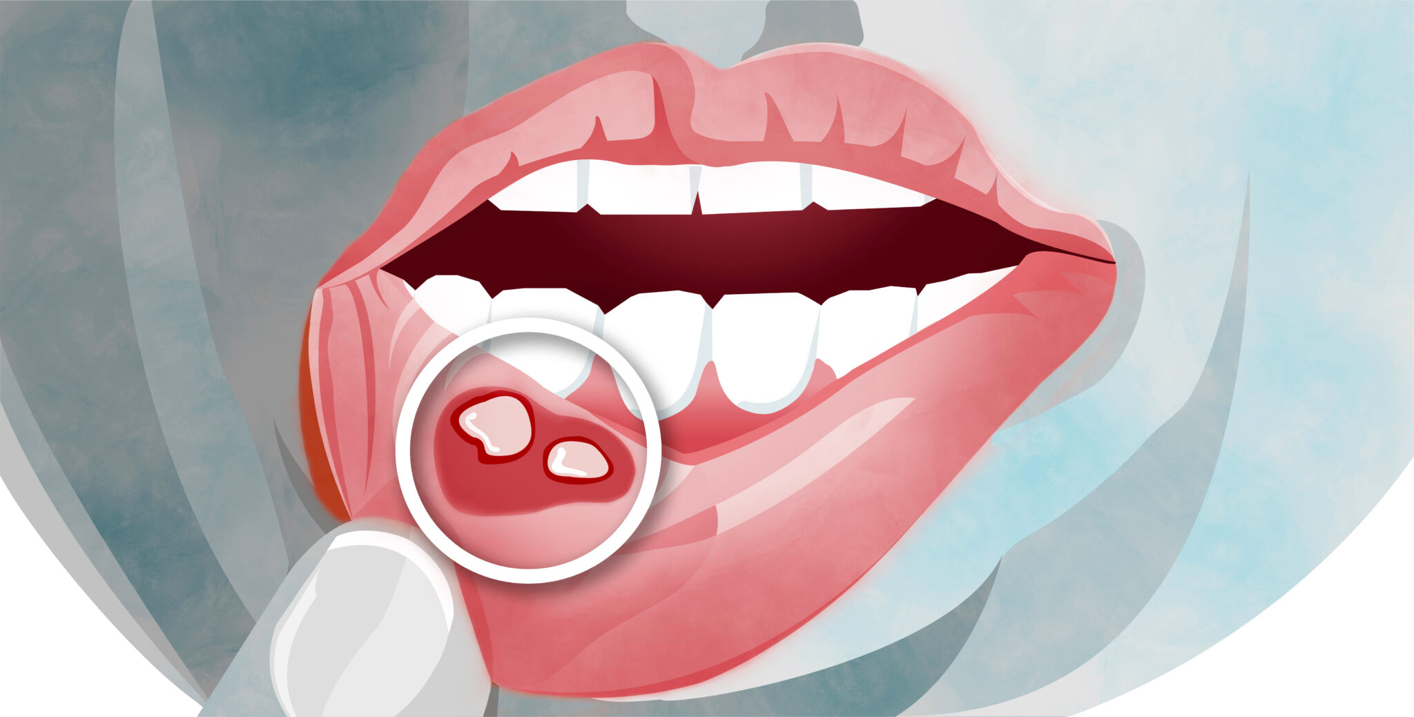 Mouth Sores And Spots On Tongue