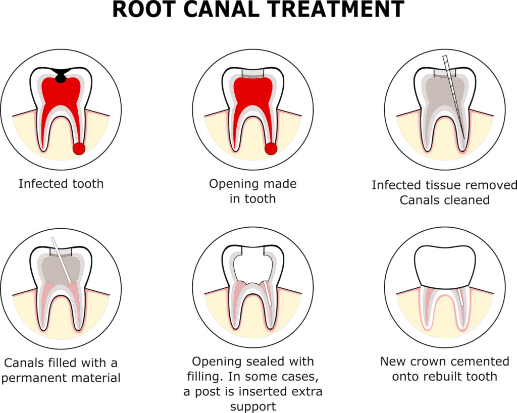 infographic of root canal treatment