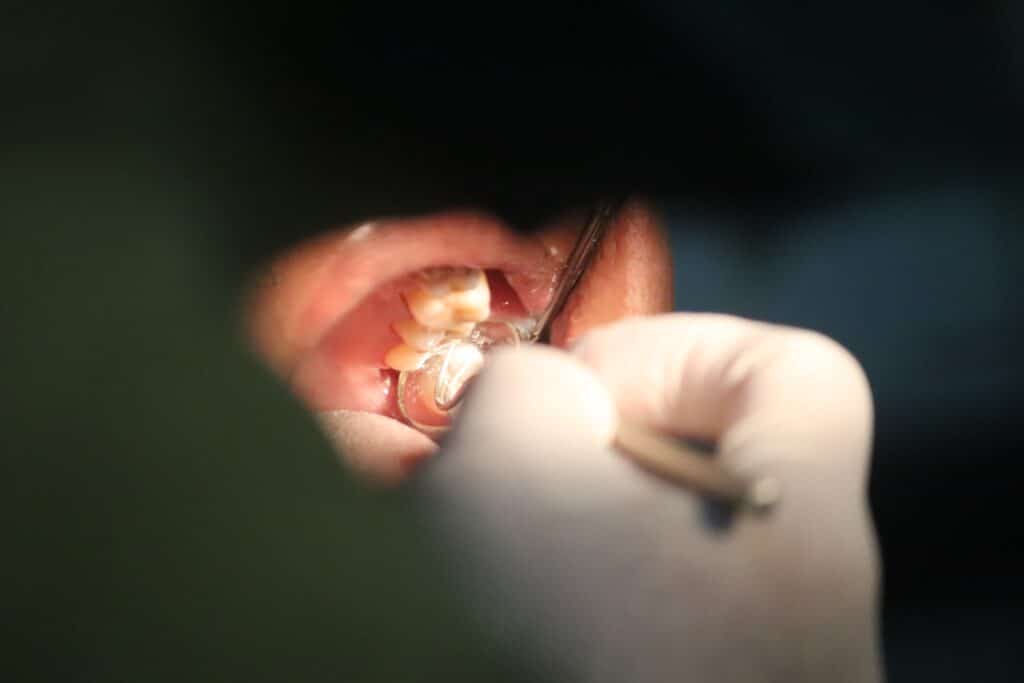 image of doctor checking for cavity