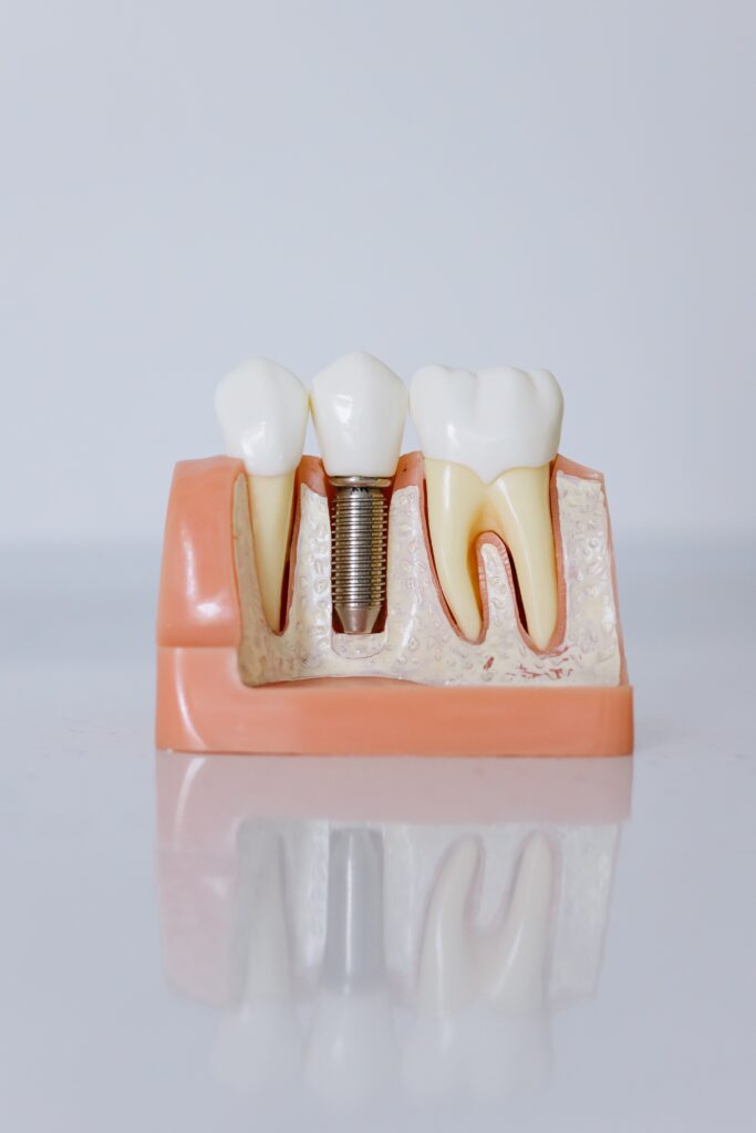 image of dental implant